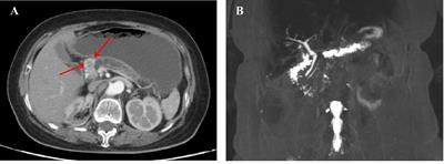 Case Report: Pancreatic metastasis of renal cell carcinoma 16 years after nephrectomy